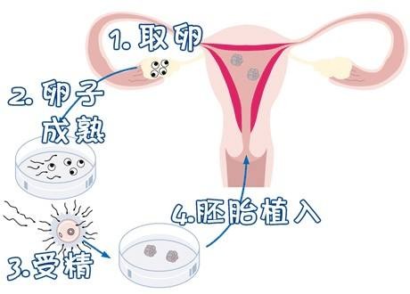 包生男孩助孕机构代生供卵医院